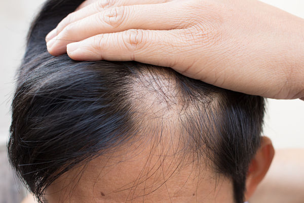 y Finasterida contra la alopecia: ¿qué y para qué