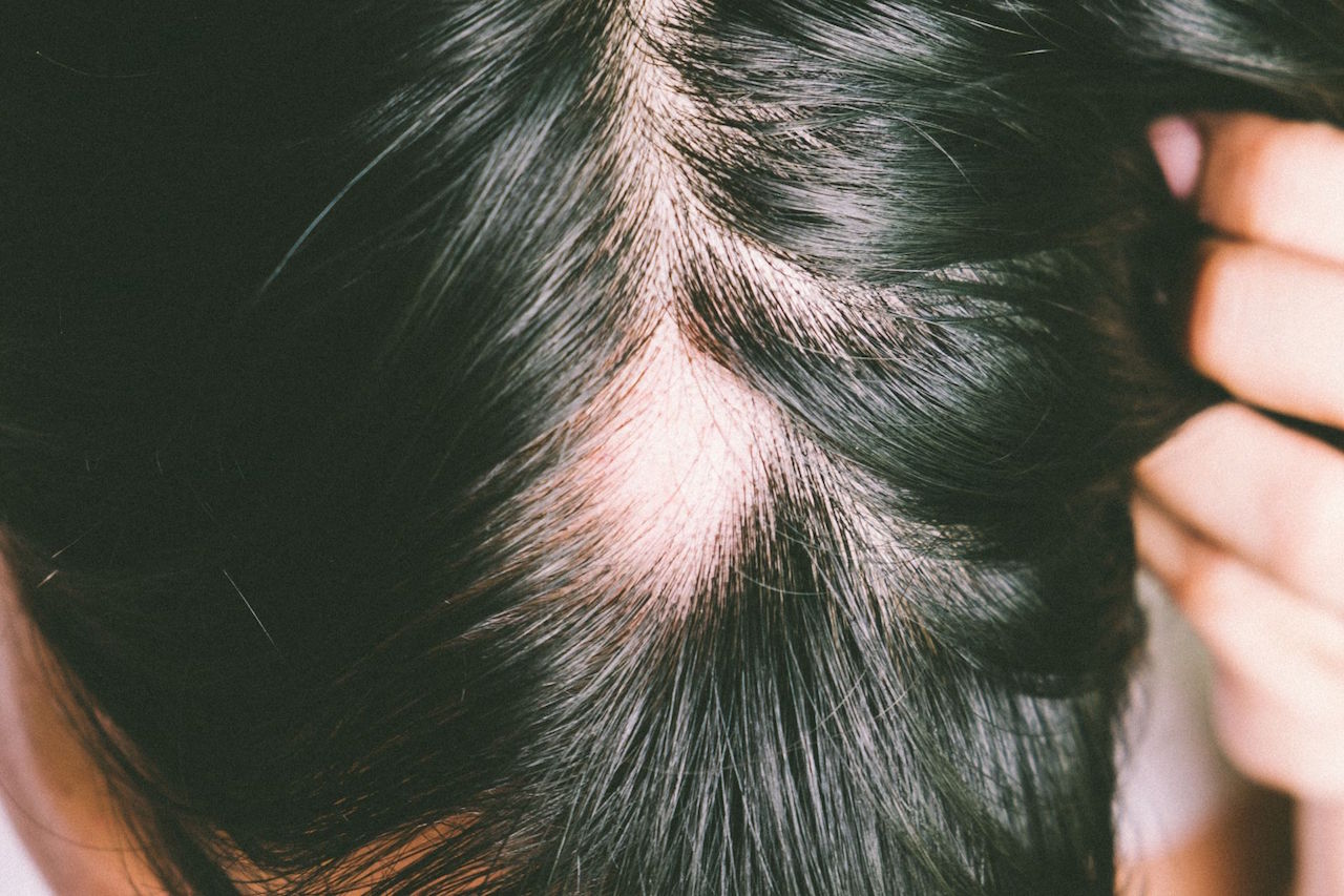 Alopecia Areata estrés. ¿Es verdad que ambos están relacionados? -