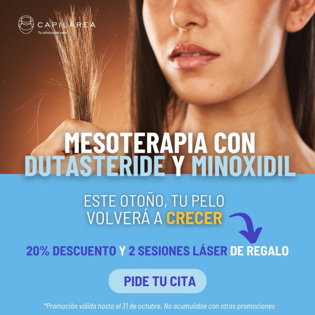 Mesoterapia con Dutasteride y Minoxidil