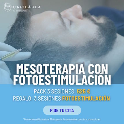 Mesoterapia capilar con Bioestimulación