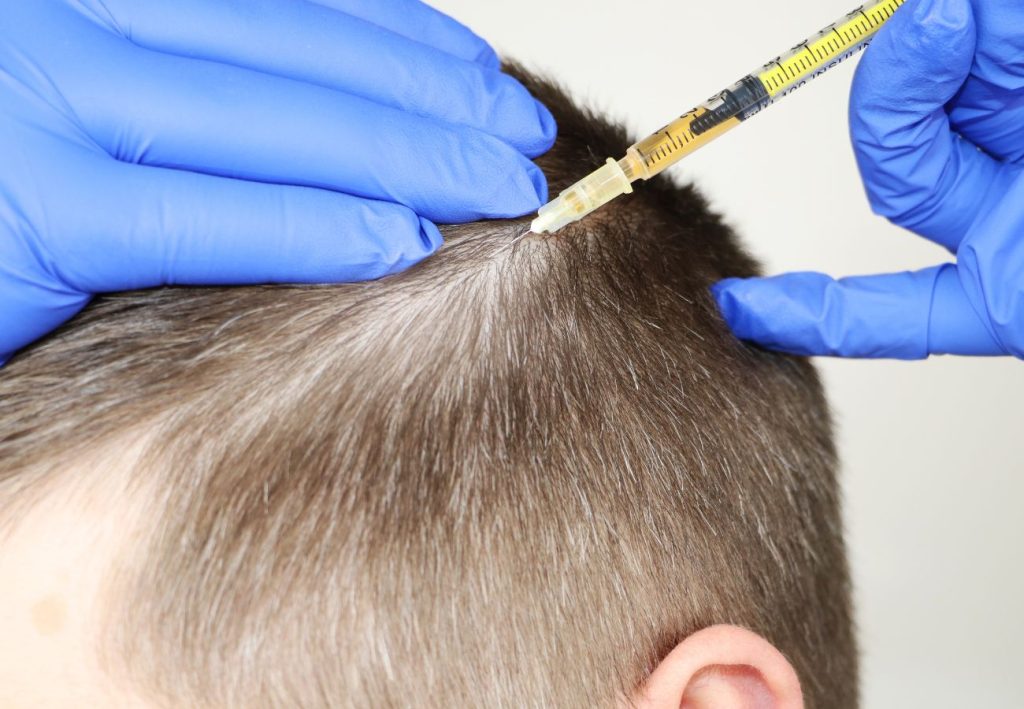 Opiniones y reseñas sobre el tratamiento de Mesoterapia capilar contra la alopecia