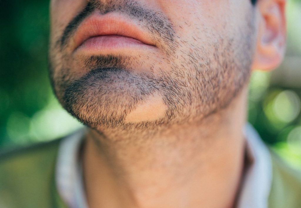 Alopecia Areata en barba