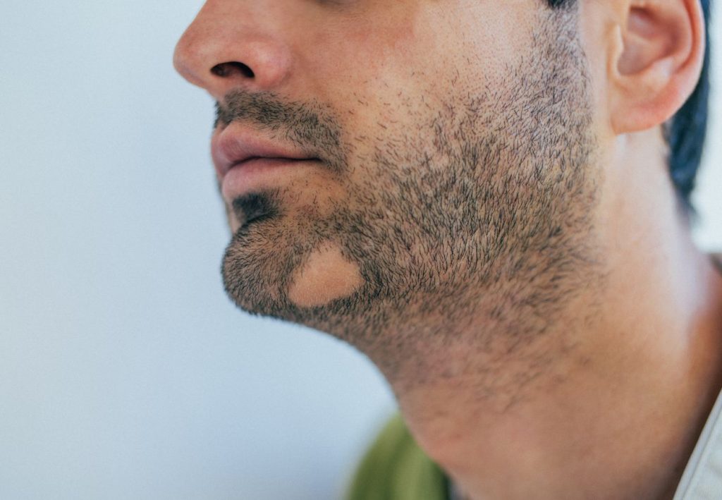 Hombre con Alopecia Areata en barba